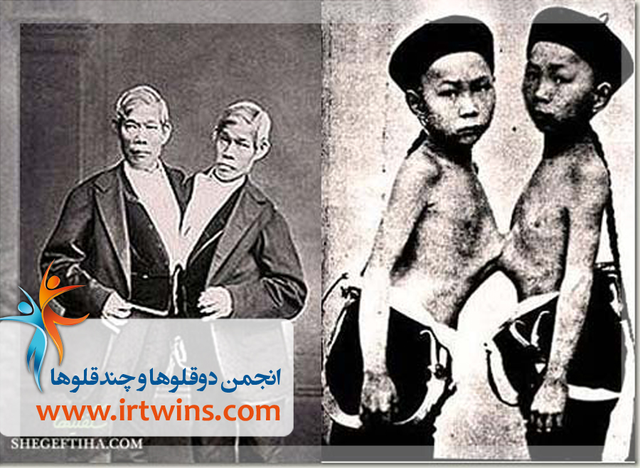 twins-liver-stick-together